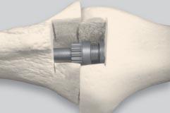 It is helpful to apply constant downward pressure to the compression screw until the threads adequately engage the femoral component; otherwise the compression screw may drop away from the tibial