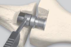 (CAUTION: Avoid over-tightening as an intraoperative fracture may occur with excessive force.