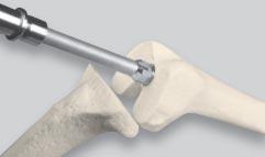 Femoral Reaming The femoral reamer is used to prepare the femoral canal (Figure 1).