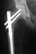 1 : Pre-operative X-Ray Fig.