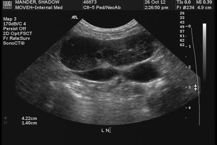 Particular HS - Shadow! Blood work: normal! Abdominal ultrasound: multiple enlarged LNs!
