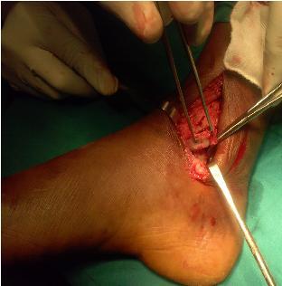 The repair of a ruptured deltoid ligament is not necessary in ankle fractures. J Bone Joint Surg Br. 1995; 77(6):920-1. 15. Vander Griend R, Michelson JD, Bone LB.
