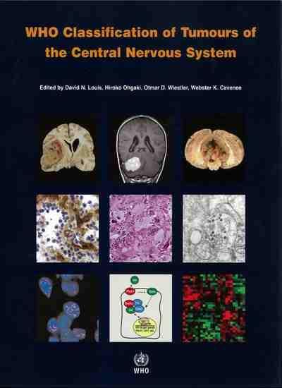Primary tumours of CNS International standardised classification system Tumours graded from I to IV Light