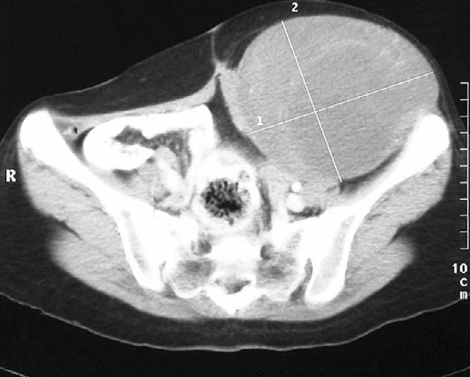 LARGE DESMOID TUMOUR OF ANTERIOR ABDOMINAL WALL crest was resected en bloc. The specimen weighed 1.