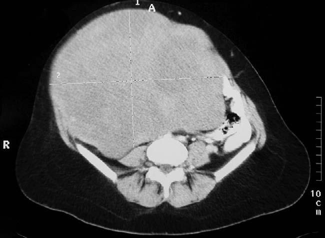 Abdominal CT showed that the mass arose from the muscles of the anterior abdominal wall (Figure 9) and biopsy confirmed features consistent with a desmoid tumour.
