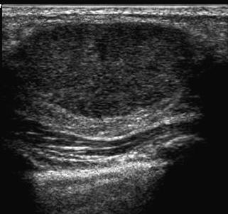 Ultrasound Ultrasound Tissue Composition Only for screening Homogeneous background fat Homogeneous background fibroglandular Heterogeneous background Ultrasound Ultrasound Masses Calcifications
