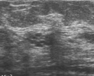 Can be palpable in <40 years old Isolated complicated cyst Clustered microcysts Category 2 if very well seen and all cystic Category 3 Ultrasound Summary Six month unilateral (or bilateral) 1 year