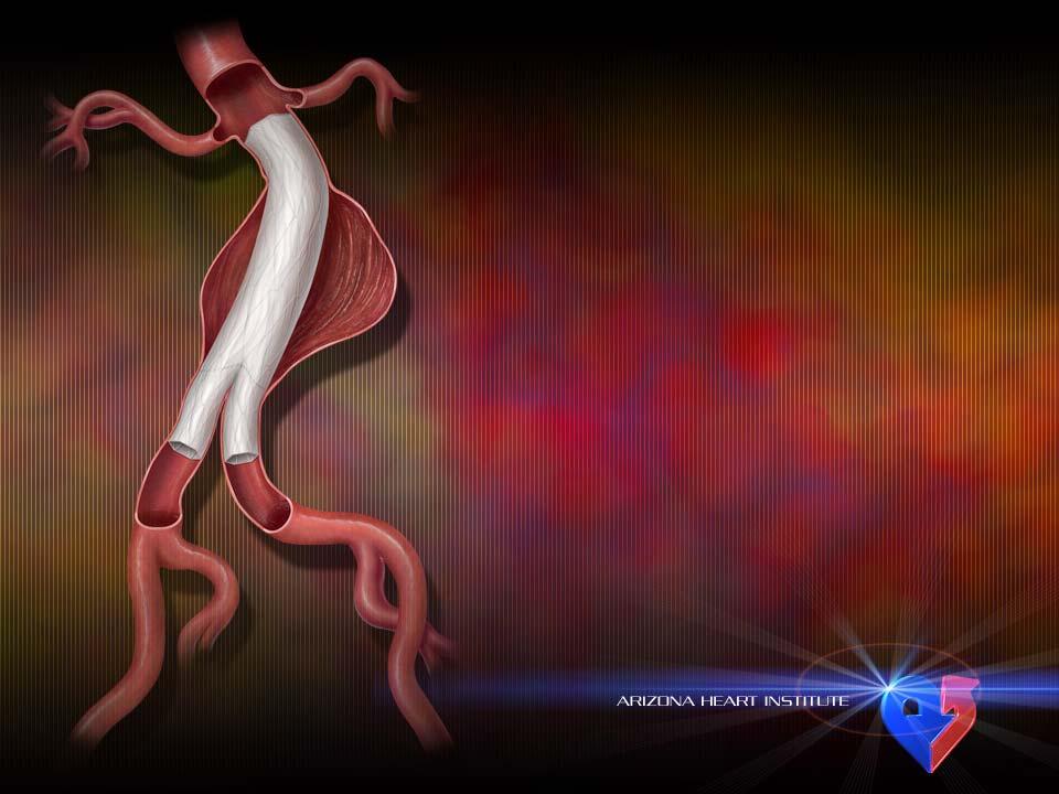 Anatomical Fixation Mimics the shape of the natural aorta Sits at the bifurcation Provides support