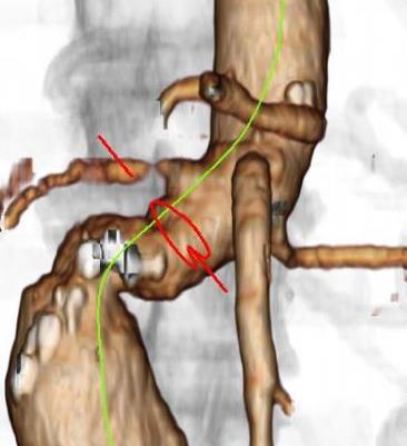 Expanding EVAR applicability in complex proximal aortic neck Precise deployment with