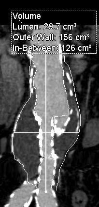 INCRAFT in complex proximal