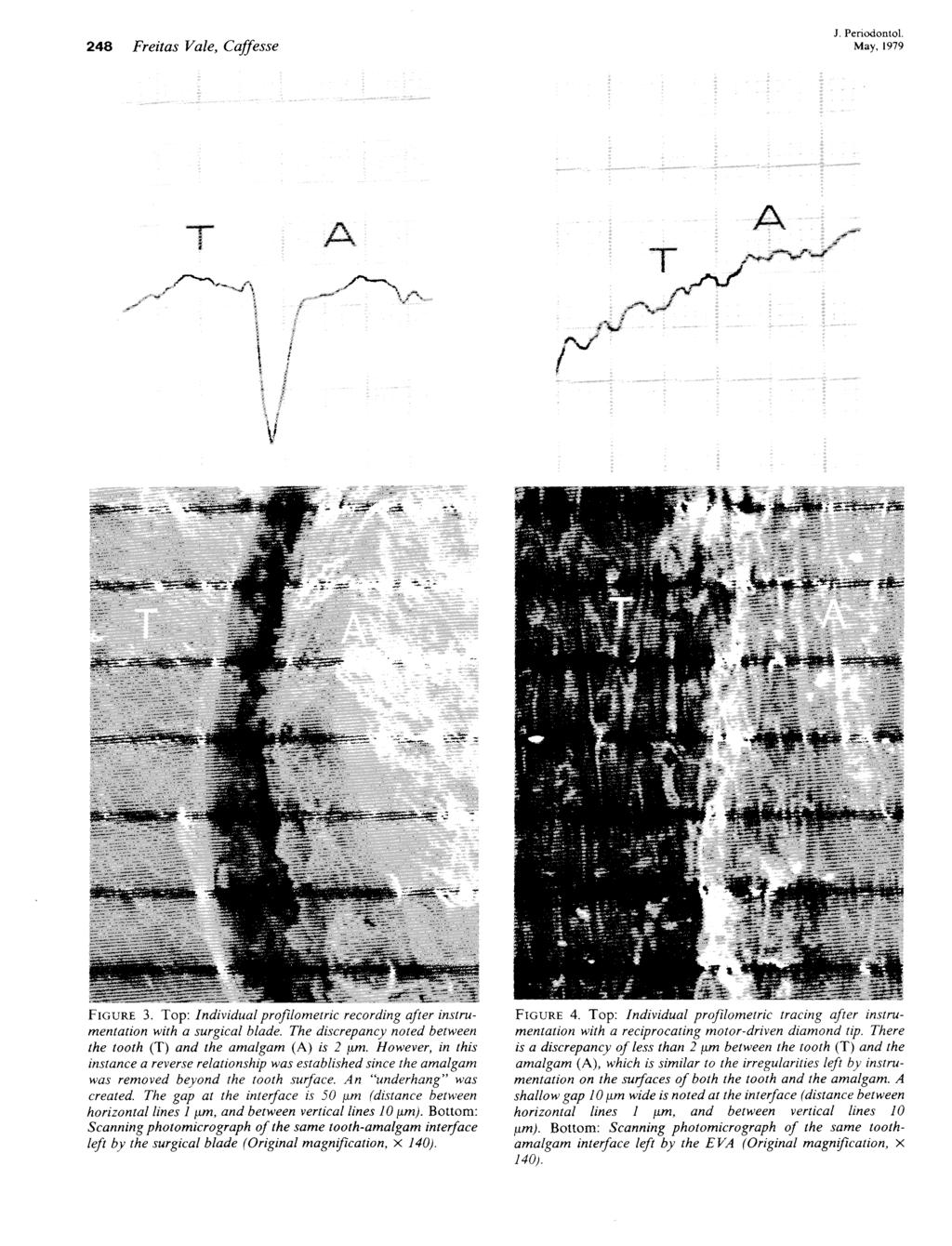 248 Freitas Vale, J. Periodontol. Caffesse Figure 3. Top: Individualprofilometric recording after instrumentation with a surgical blade.