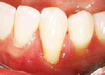 As a practicing periodontist, I ve found that recognizing, diagnosing and understanding treatment options for gingival recession remains a confusing mystery to many dentists.