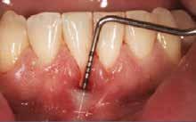 Some practitioners will graft sites that have minimal (less than 2mm) attached gingiva but, put simply, if a tooth has no attached gingiva, it s indicated for a tissue graft.