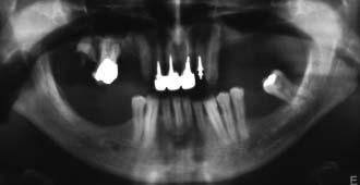644 Fig 1 (left) Pretreatment panoramic radiograph. Note the extensive alveolar bone loss. Fig 2 (above) Clinical view of the remaining teeth. Note the loss of vertical dimension.