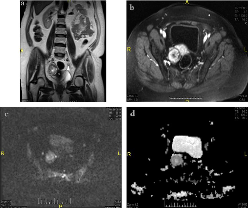 116 R.R.H. yousef et al. Table 2 Shows the variation in signal intensity between the benign and malignant solid adnexal lesions on DWI. Signal intensity Benign lesion Malignant lesion P value (No.