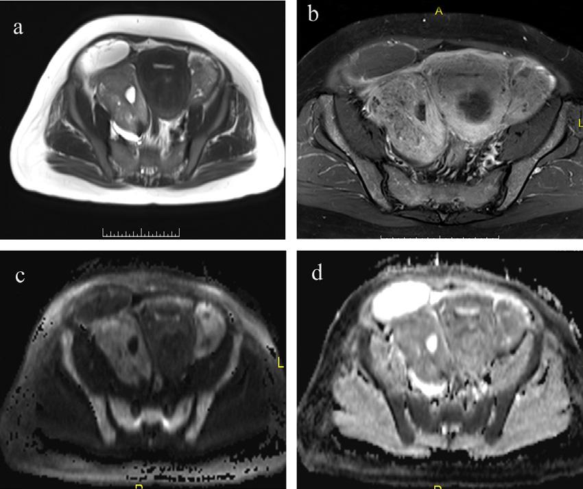 118 R.R.H. yousef et al. Fig. 4 Pathologically proved metastatic ovarian adenocarcinoma. (a) HASTE axial shows mainly solid bilateral ovarian lesions.