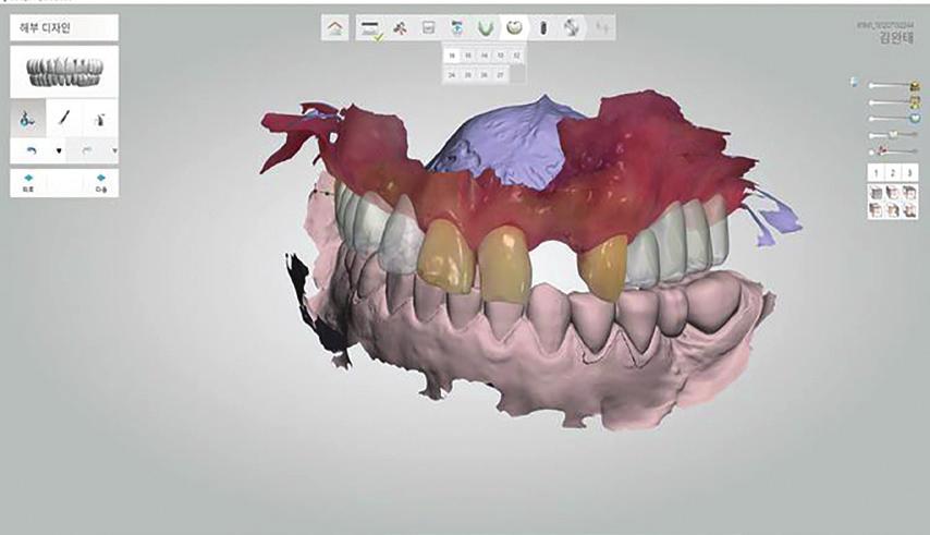 Fig. 7. Designing Provisional Crowns in Implant Studio As seen in fig.