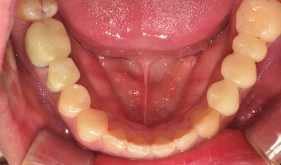 The prepared anterior abutment teeth