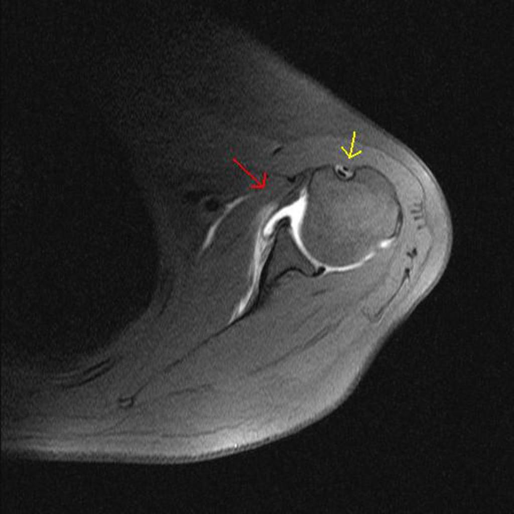 Fig. 5: Axial image showing the subscapularis (red arrow) and