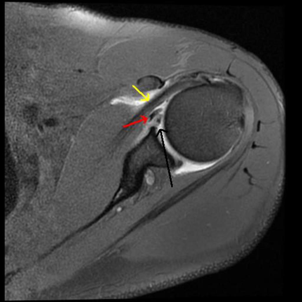 Fig. 12: Axial image of Sublabral foramen (black arrow), Middle
