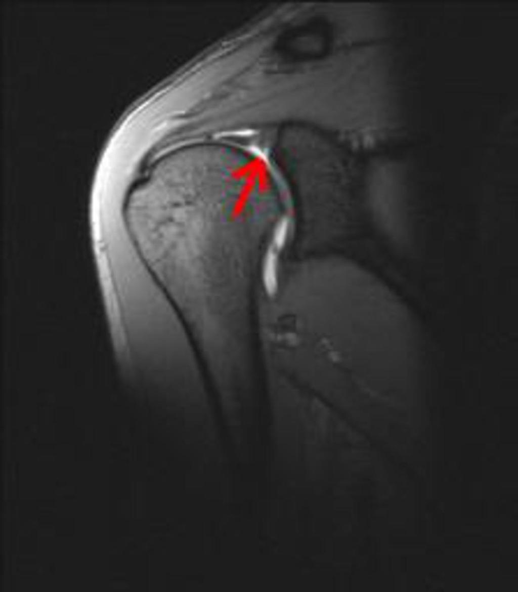 Fig. 16: Sublabral recess (arrow), this does not