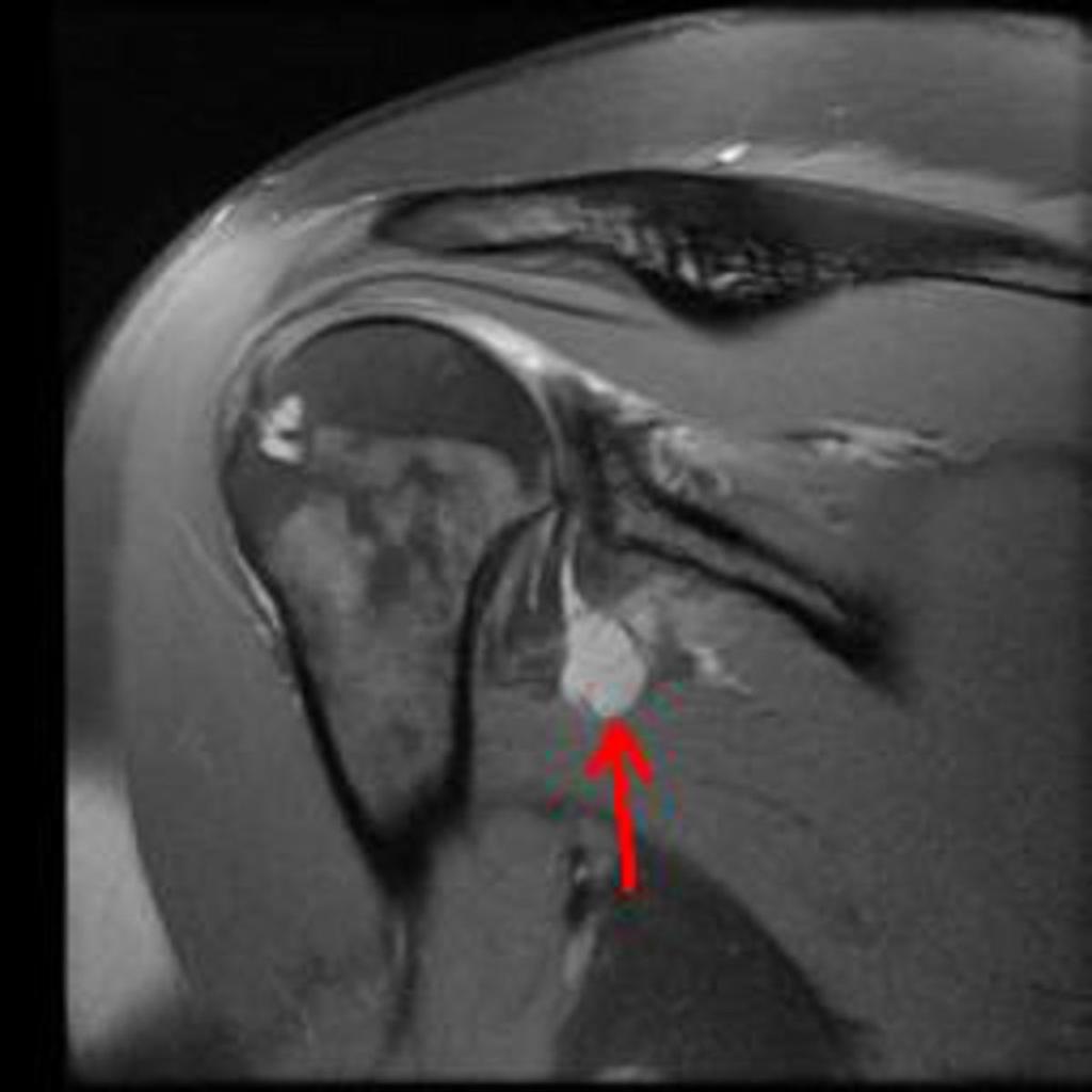 Fig. 30: Labral cyst