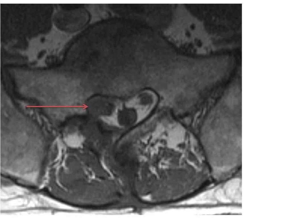 Fig. 2: Non-contrast Ax T1W image at L5/S1 shows T1 hypointense material (red arrow) replacing the epidural fat within the right lateral recess.