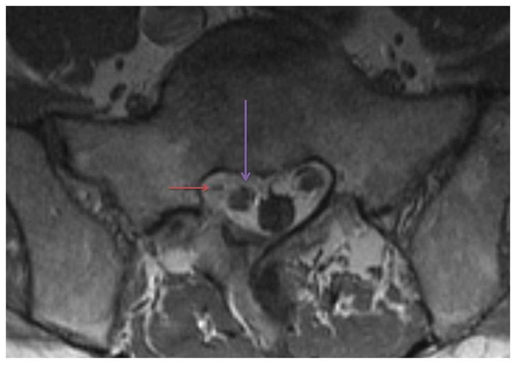 Fig. 3: Post contrast Ax T1W image corresponding to image 2 shows avid enhancement of the previously shown T1 hypointense material which is shown to partially encase the right S1