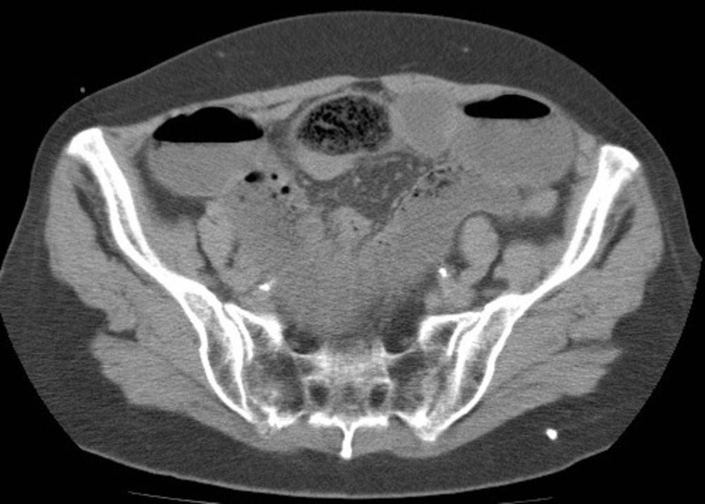 Fig. 3: 63 year-old man with a small-bowel bezoar.