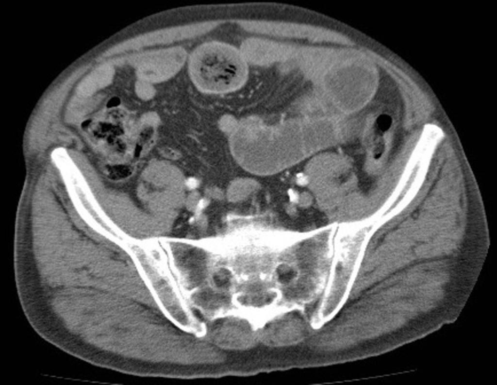 Fig. 5: 67 year-old man with a small-bowel bezoar.
