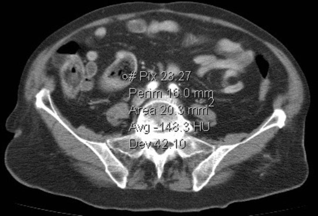 Fig. 6: 76 year-old woman with a small-bowel bezoar, showing fat-density