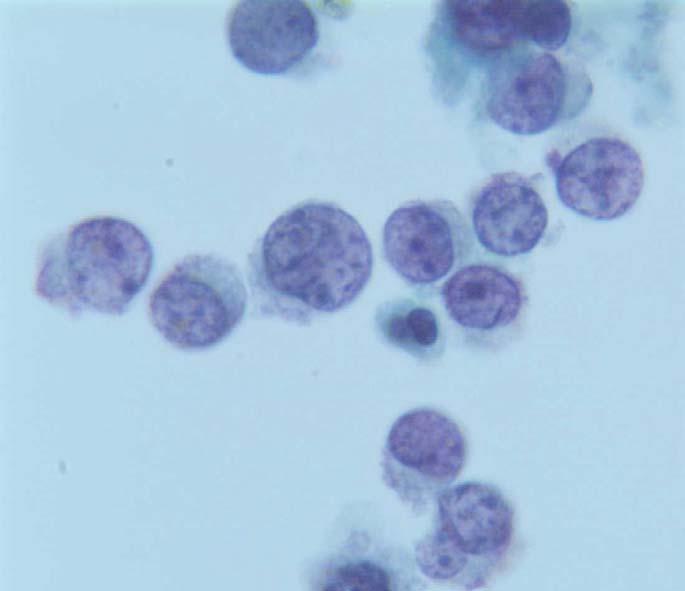 Primary Effusion Lymphoma Body cavity based lymphomas are usually seen in immunosuppressed individuals and are composed of large cells, often with an immunoblastic or plasma cell appearance.