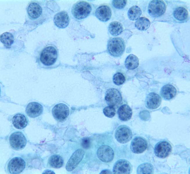 The cells have coarse chromatin and deep blue cytoplasm with vacuoles.