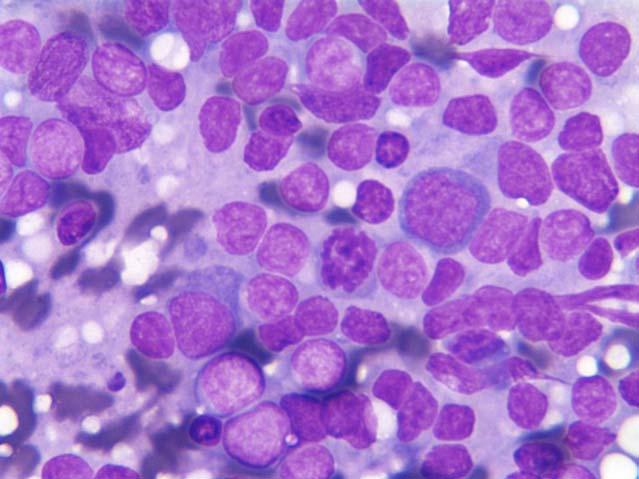 Peripheral T cell Lymphoma, NOS Image 22 : The cytologic spectrum of Peripheral T cell lymphoma