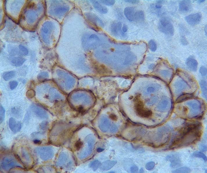Anaplastic Large Cell Lymphoma A B Image 24: A demonstrates Ki1(CD30)