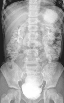 KUB post-ct 92-10-09 Negative of the abdomen.