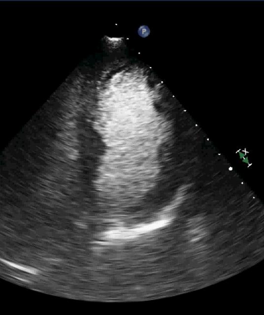 Contrast for LV Opacification Commercial Contrast Improve endocardial border