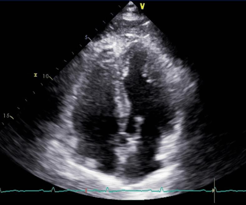 Crista Terminalis Normal structure Often confused for a right atrial mass