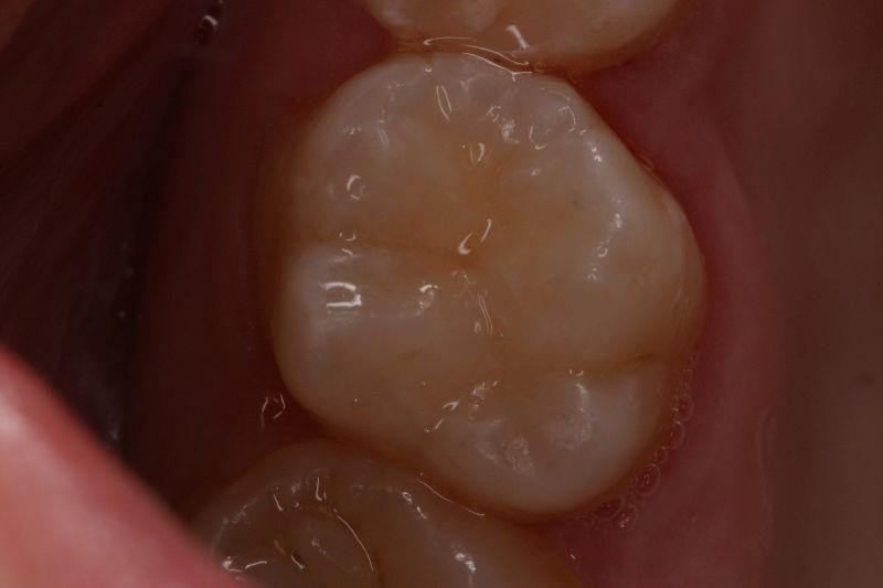 Case Study A 42-year-old male patient presented with decay in the upper left first molar.
