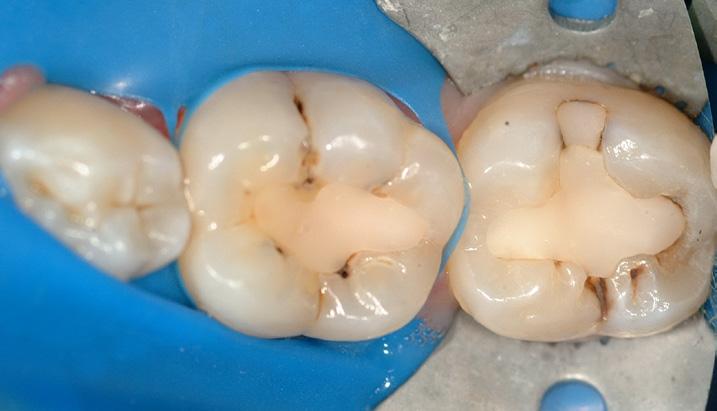 Performing Efficient Posterior Restorations How to Save Time Without Cutting Quality in a Bulk Fill Composite Read the full case here By Daniel Poticny, DDS* As a doctor, I always want to make sure