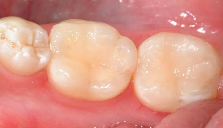 Case Study In the following case, a 34-year-old female needed to replace two restorations that were both fractured, chipped, leaking and had recurrent caries. The Procedure 1.