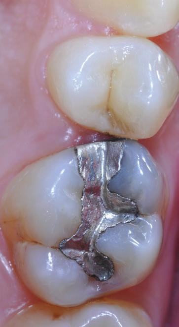 Case Study This case involves a 35-year-old female patient who came into the dental clinic with primary and