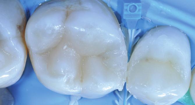 These caries were located in the upper premolar and molar teeth and were causing the patient a lot of pain.