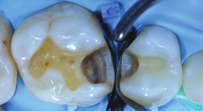 Initial Situation: Replacement of an insufficient amalgam restoration of first upper molar and treatment of