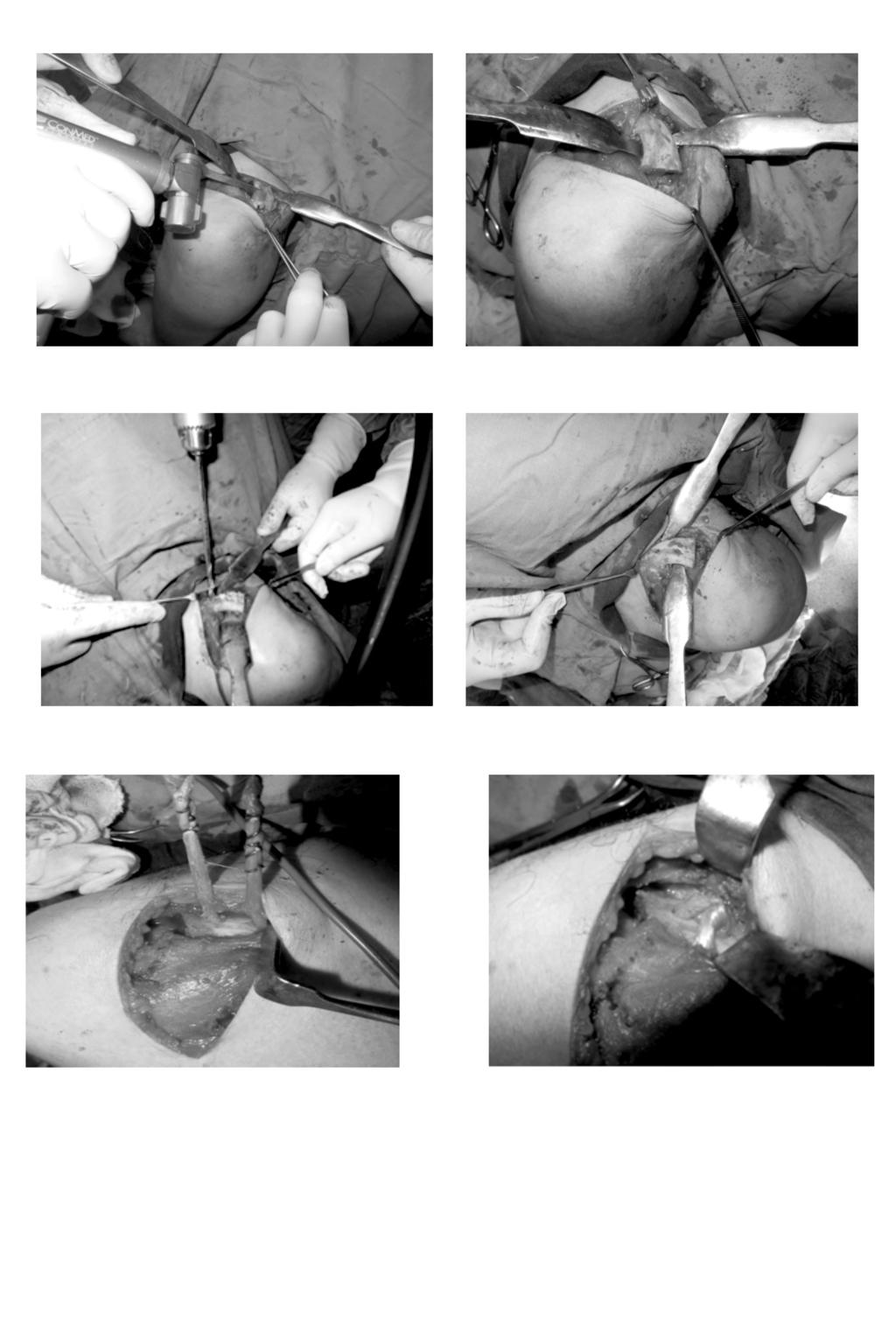 22 Reconstruction of AC Joint Dislocation with Hamstrings Autograft (A) Fig. (5): Distal 10mm of the clavicle was removed using an oscillating saw. (B) (A) Fig.