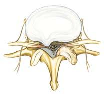 4. A disc herniation or disc protrusion reduces the diameter of the spinal canal. These changes often occur together and cause spinal canal narrowing.