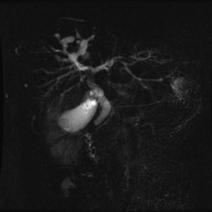 MRCP Abnormal biliary tree with focal dilatation and widespread strictures.