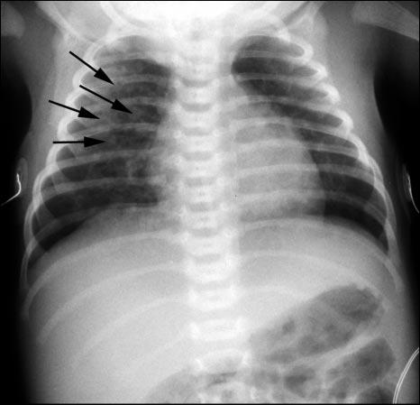 Figure 3. Chest radiograph of an infant who has transient tachypnea of the newborn. Arrows point at fluids in the interlobar fissures.