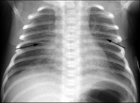 Chest radiograph of an infant who has meconium aspiration syndrome, with course patches of atelectasis (arrows). Areas of hyperinflation also are present, best seen at both lung bases. Figure 5.