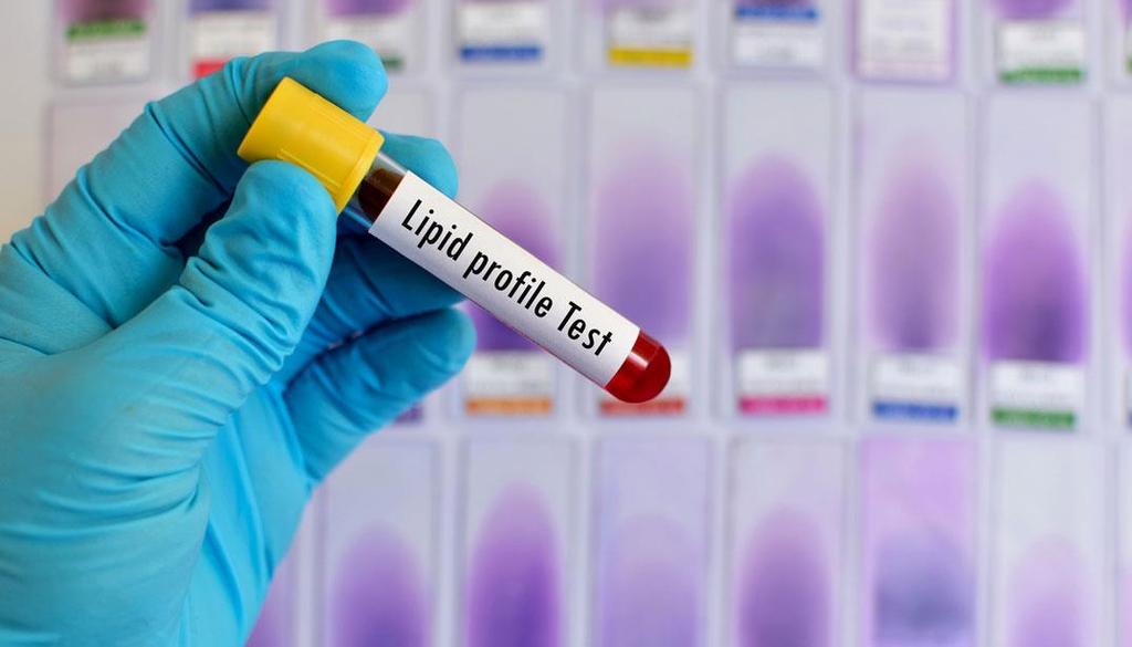Your Lipid Profile When doctors order a lab test called a lipid profile (sometimes called a lipid panel), they are looking for information about the amounts of four types of